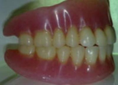 دندان مصنوعی در طول تاریخ
